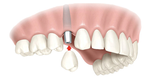 Single Dental Implants Atlanta
