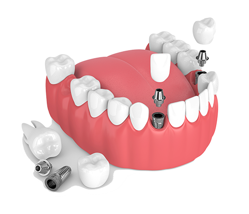 Multiple Teeth Dental Implants in Georgia